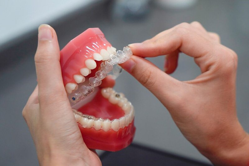 The Invisalign Guide to Straighter Teeth - Maple Ridge Smiles Dental