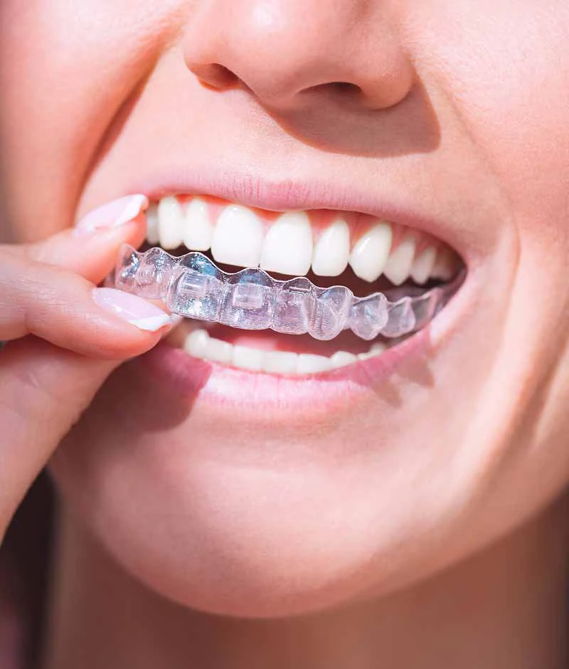 Invisalign Maple Ridge, BC