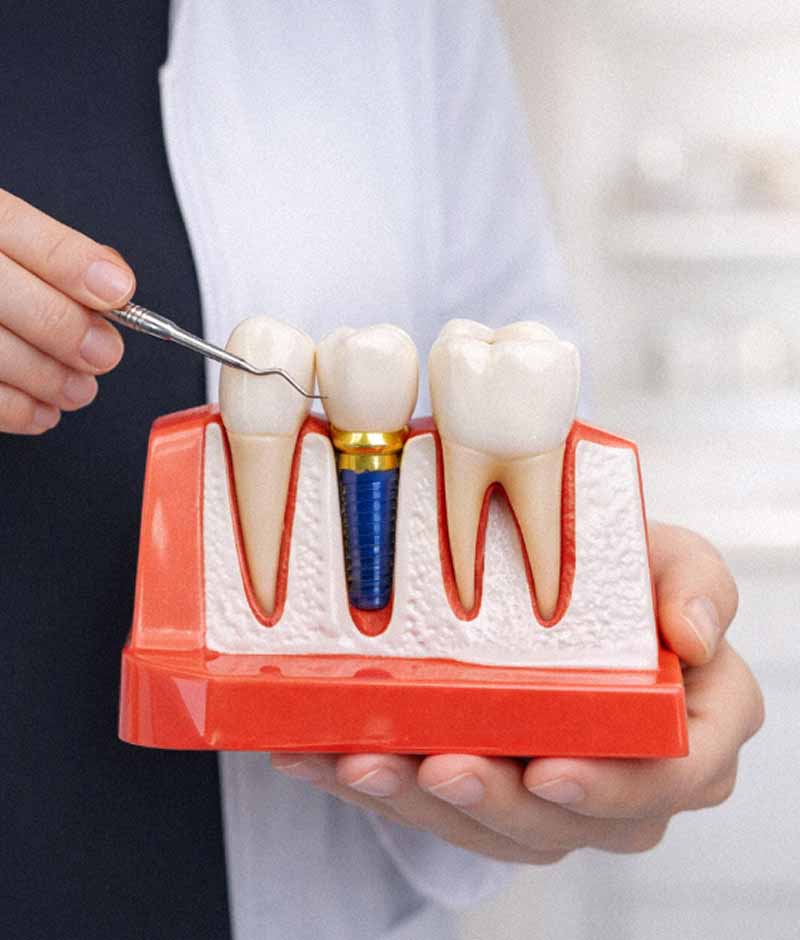 3D model showing how a dental implant works